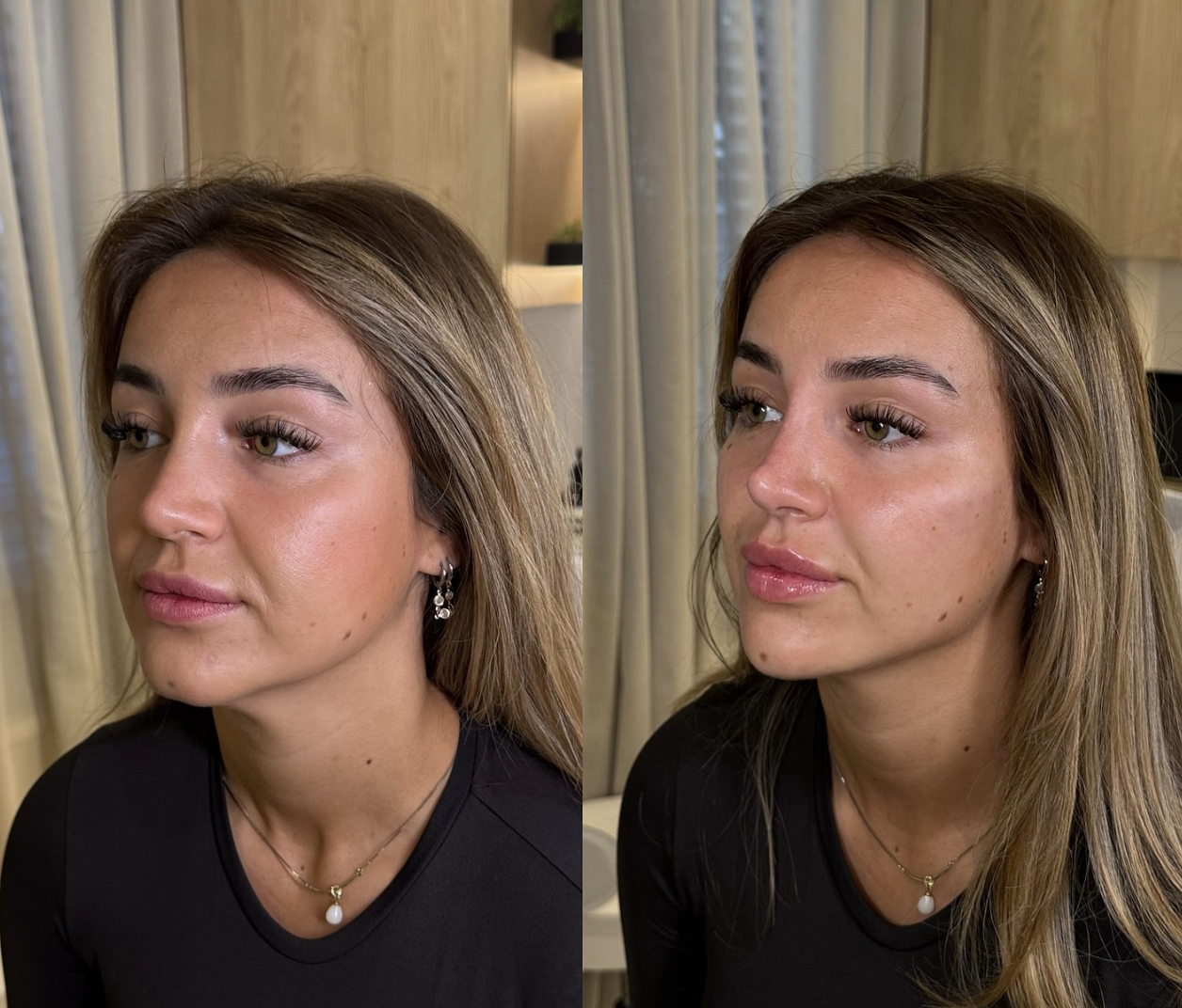 Before and after lip enhancement