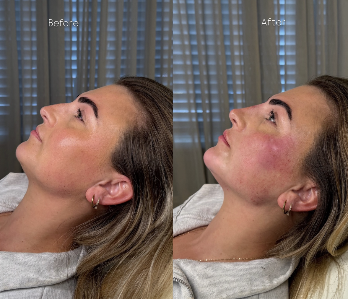Before and after skin treatment