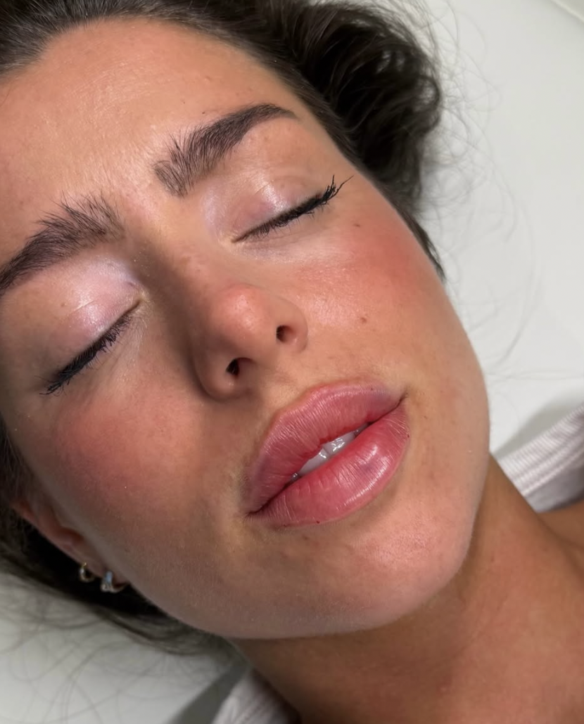 Dermal filler treatment
